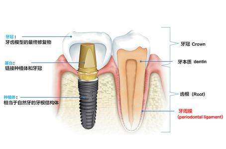 种植牙的效果好不好