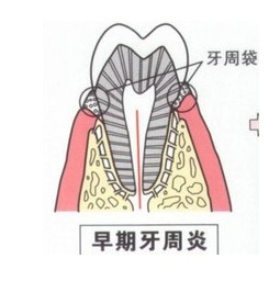 牙齿根尖周炎该怎么处理