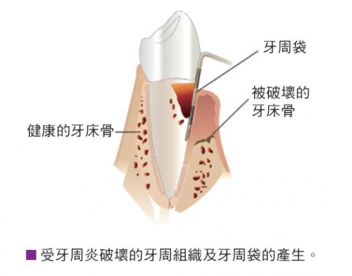 得了牙周病怎么办