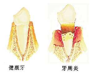 怎么样是有牙周炎