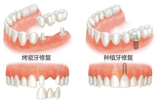 做颗纯钛烤瓷牙要多少钱