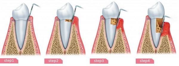 牙周炎怎么治疗