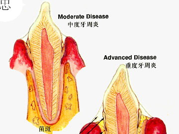 牙龈肿痛怎么办呢