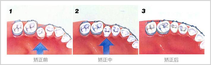 带牙套矫正牙齿要多少钱